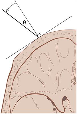 Technical Comparison of Treatment Efficiency of Magnetic Resonance-Guided Focused Ultrasound Thalamotomy and Pallidotomy in Skull Density Ratio-Matched Patient Cohorts